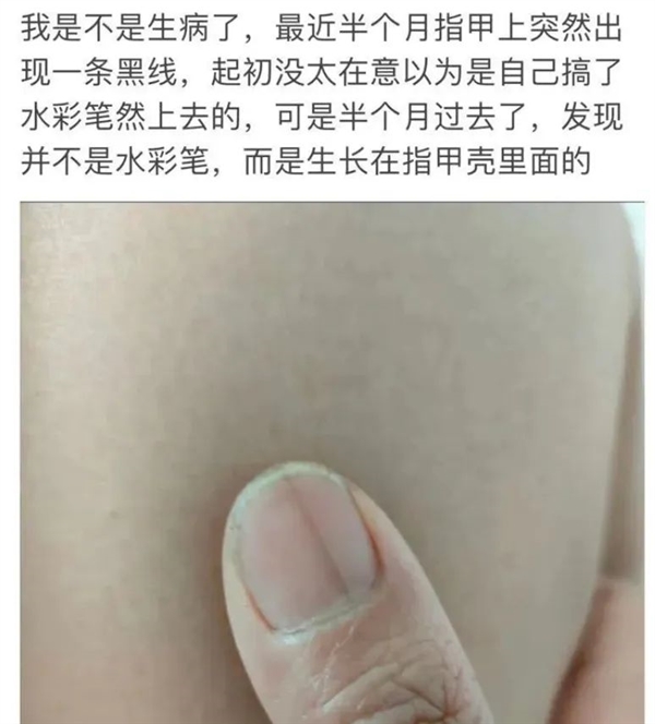 指甲出现一条黑线别不当回事！可能是癌变