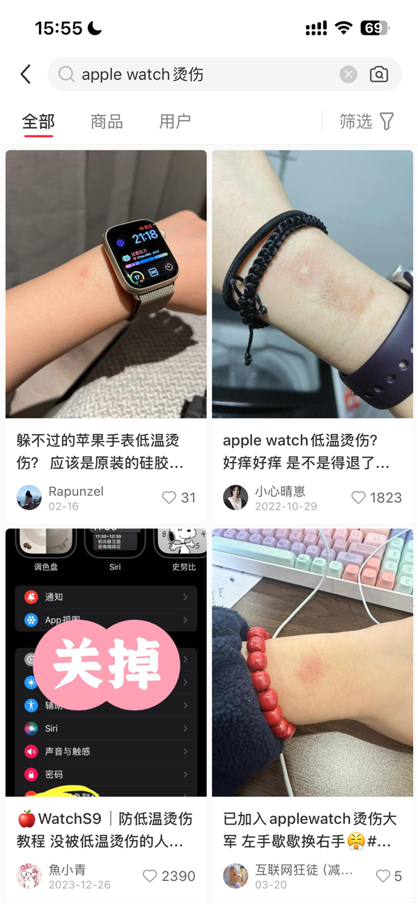 女子戴AppleWatch睡觉被烫伤起泡苹果客服回应：过敏反应