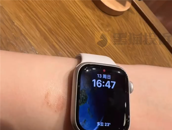 女子戴AppleWatch睡觉被烫伤起泡苹果客服回应：过敏反应